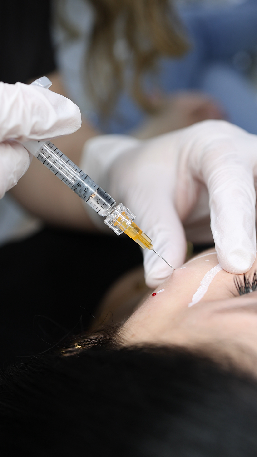 Anti-Wrinkle Injections