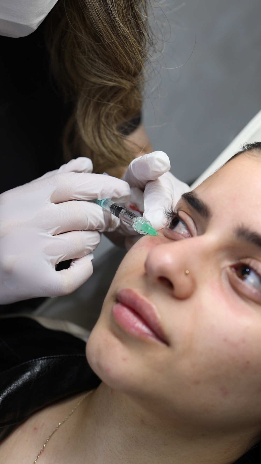 Microneedling