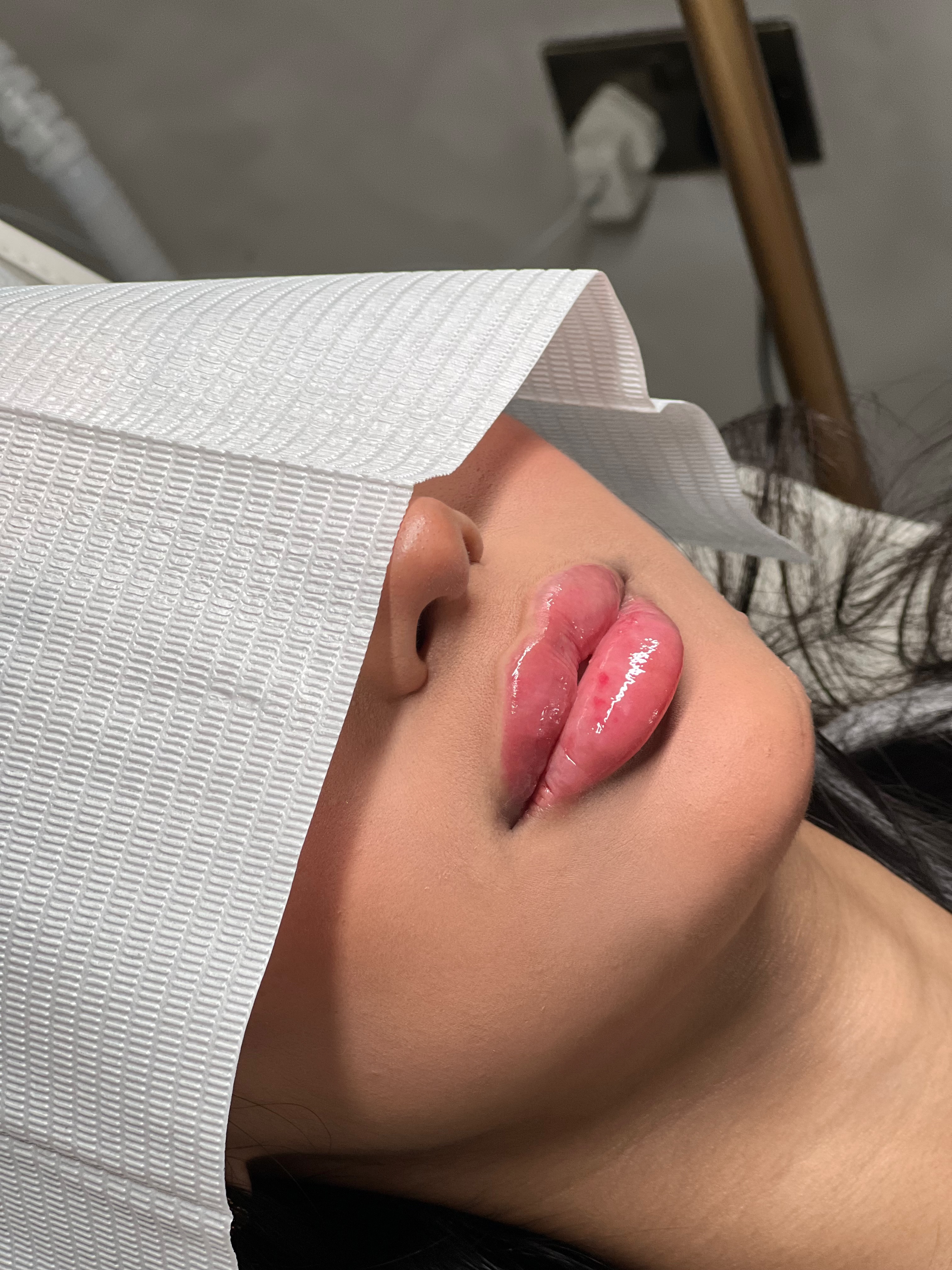 Dermal Fillers