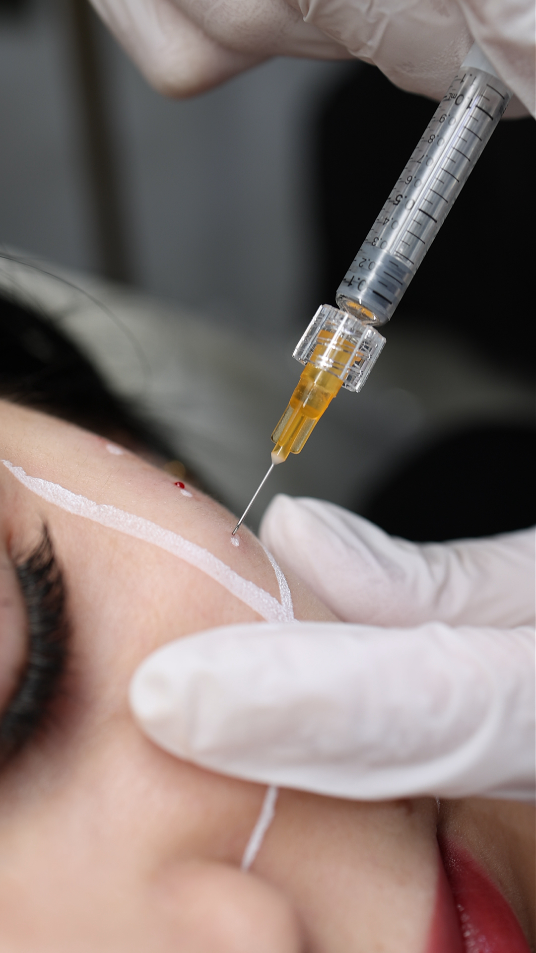Skin Boosters